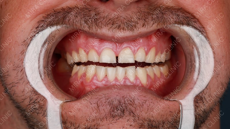 Thomas’s Dental Problem – Gummy Smile